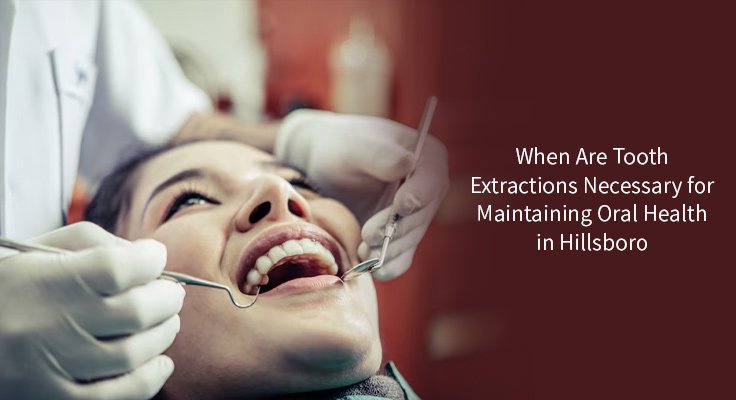 Tooth Extractions