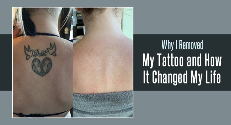 Tattoo Removal