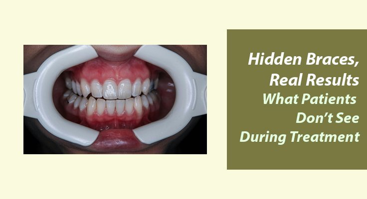 Hidden Braces