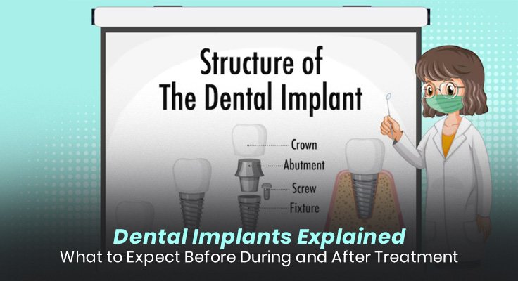 Dental Implants Explained